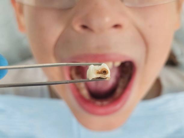 Best Emergency Treatment for Dental Infections or Abscesses in North Hornell, NY